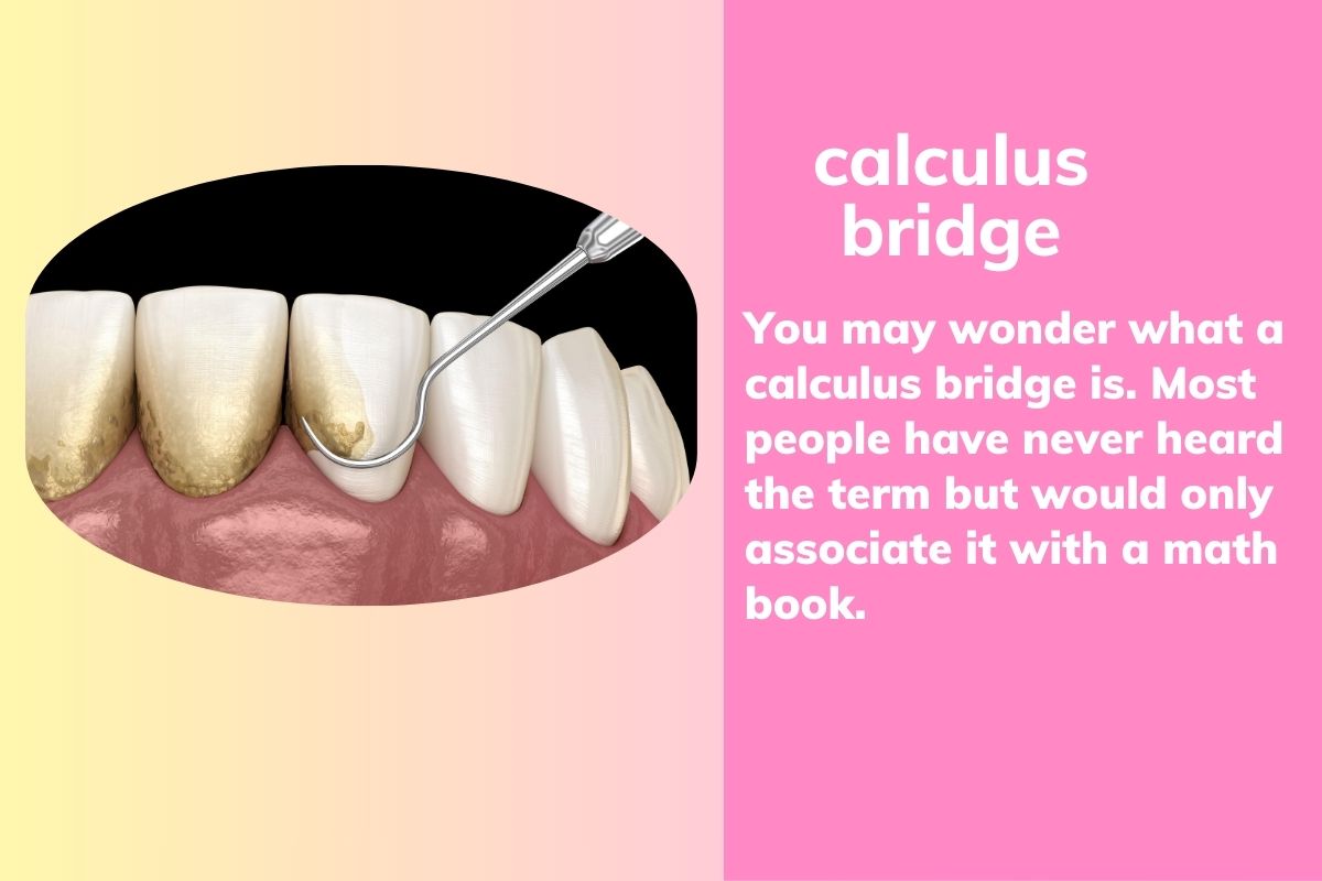 A calculus bridge is hardened plaque buildup on teeth, leading to gum disease and tooth decay. Prevent it with regular brushing, flossing, and dental cleanings.